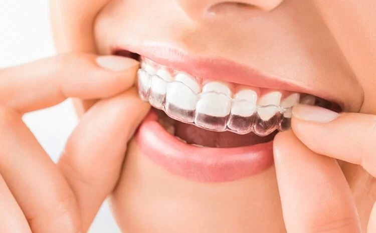 Smile Designing Treatment in Kothrud Pune