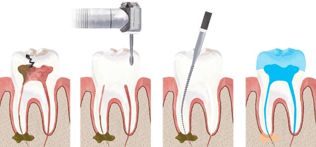 Root Canal Treatment in Kothrud Pune