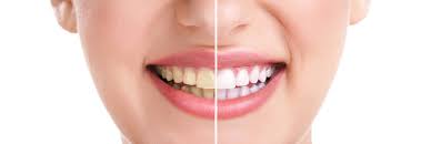 Smile Designing Treatment in Kothrud Pune