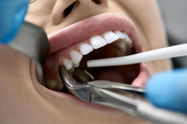 Tooth Extraction in Kothrud Pune