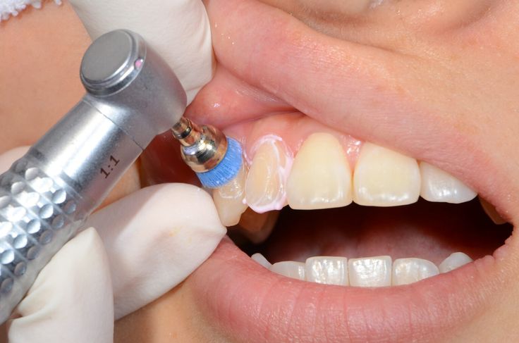 Teeth Cleaning and Polishing